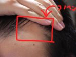 AGA治療２４日目　M字の産毛と頭頂部の写真
