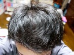 AGA治療124日目　4ヶ月間の治療経過【写真あり】