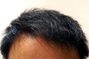 AGA治療4年10ヶ月目