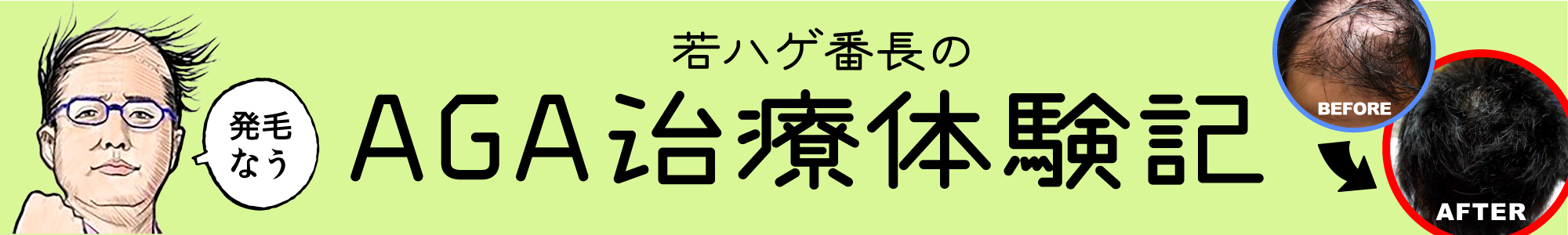 若ハゲ番長のAGA治療体験記＠育毛研究室