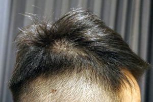 AGA治療6年3ヶ月目側頭部右
