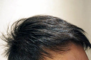 AGA治療6年6ヶ月目生え際右